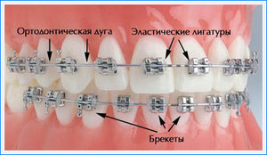 снять брекеты