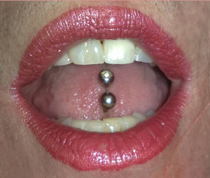 The second labret in the tongue