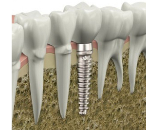 Имплант зуба
