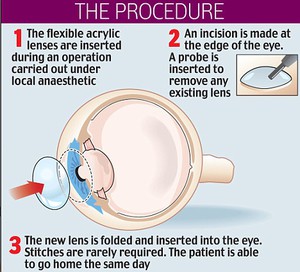 Ocumetics Bionic Lens (x2)