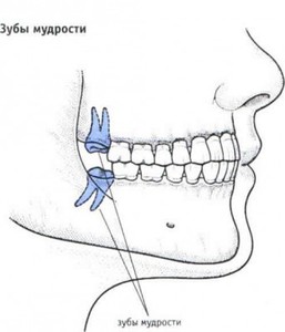 Вырвать зубы мудрости