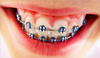 braces