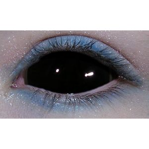 Black sclera