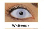 white out contacts